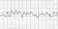 Gráfico de un electrocardiograma em Fibrilación Ventricular, mostrando subidas y bajadas  totalmente irregulares em amplitud e intensidad.