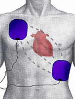 Ilustración de un dorso de un hombre sobre el que hay colocados dos electrodos de un DESA, uno sobre el pectoral derecho del paciente, y otro en el lado izquierdo del paciente situado en el lateral, sobre las costillas, justo debajo del pectoral. También se ve en la ilustración el lugar que ocuparía el corazón, justo en mitad del camino de las corrientes que circulan entre ambos electrodos en la descarga.