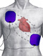 Ilustración de un dorso de un hombre sobre el que hay colocados dos electrodos de un DESA, uno sobre el pectoral derecho del paciente, y otro en el lado izquierdo del paciente situado en el lateral, sobre las costillas, justo debajo del pectoral. También se ve en la ilustración el lugar que ocuparía el corazón, justo en mitad del camino de las corrientes que circulan entre ambos electrodos en la descarga.