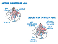 Representación de las vías respiratorias,  de sus  músculos y de los alveolos pulmonares antes y después de un episodio de asma. Después , las vías aéreas están llenas de moco e hinchadas, y los músculos contraídos alrededor de la vía aérea, dificultando la entrada de aire.