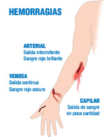 Ilustración en la que aparece un brazo con tres tipos diferentes de hemorragias. Una hemorragia arterial con salida intermitente de sangre rojo brillante. Una hemorragia venosa con salida continua de sangre rojo oscuro y una hemorragia capilar con poca salida de sangre.