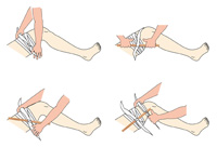 Ilustración en cuatro pasos en la que se observa la colocación de un torniquete en el muslo. Se coloca una tira de tela ancha alrededor del muslo. Se hace un nudo y se coloca un elemento rígido sobre el nudo. En el tercer paso se anuda la tela sobre ese elemento. En la cuarta imagen se ve como se fija el palo con otro trozo de venda.
