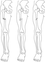 Ilustración de una pierna en la que se visualiza el hueso fracturado en su interior. Se ven tres tipos diferentes de fracturas. En la primera pierna hay una fractura completa de fémur. Los fragmentos de hueso aparecen desplazados uno respecto al otro y la zona de fractura tiene pequeños fragmentos de hueso. En la segunda pierna se ve igualmente una fractura de fémur pero en este caso la fractura es limpia sin restos de fragmentos óseos. En la tercera imagen de la pierna se ve una fractura incompleta de fémur. Se aprecia la zona de la rotura pero los fragmentos óseos están unidos y no hay desplazamiento entre ellos.