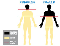 Ilustración con dos siluetas del cuerpo humano. Las siluetas están coloreadas en negro y amarillo. El color negro representa las partes que mantienen sus funciones normales. El color amarillo las partes afectadas por una lesión medular. Las líneas rojas indican el nivel de la lesión medular. En la primera silueta la línea roja está a la altura del cuello. Solo se mantienen funciones normales en la cabeza. Se corresponde a una cudraplejía.