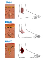 Ilustración en tres imágenes de un pie afectado de quemadura en el tobillo. La primera imagen muestra una zona enrojecida en la zona del tobillo. A su lado un detalle de la piel muestra que solo está afectada la epidermis con una anotación de 'quemadura de primer grado'. En la segunda imagen en la zona del tobillo aparecen unas pequeñas manchas rojas que representan la aparición de flictenas. El detalle de la piel muestra la afectación de la epidermis y la dermis con la anotación 'quemadura de segundo grado'. En la tercera imagen aparece una mancha negra en la zona del tobillo. El detalle de la piel muestra la afectación de la zona de la epidermis, dermis y hipodermis con la anotación 'quemadura de tercer grado'.  