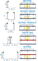 Gráfico explicativo de distintos tipos de distribución de luminarias de exterior: unilateral, bilateral pareada, bilateral tresbolillo, central axial y bilateral.