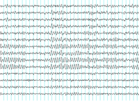 Electroencefalograma.