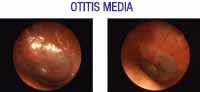 Imagen de una otitis media