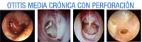 Imágenes de una otitis crónica con perforación