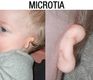 Imagen de Microtia