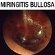 Imagen de una miringitis bullosa