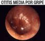 Imagen de una otitis media por gripe