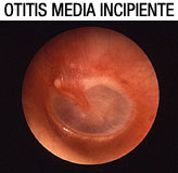 Imagen de una otitis media incipiente