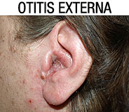 Imagen de una otitis externa