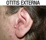 Imagen de una otitis externa