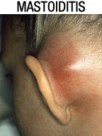 Imagen de una mastoiditis