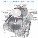 Imagen de la localización colesteatoma