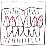 Inclinación dental de los dientes anteriores respecto a su eje axial.