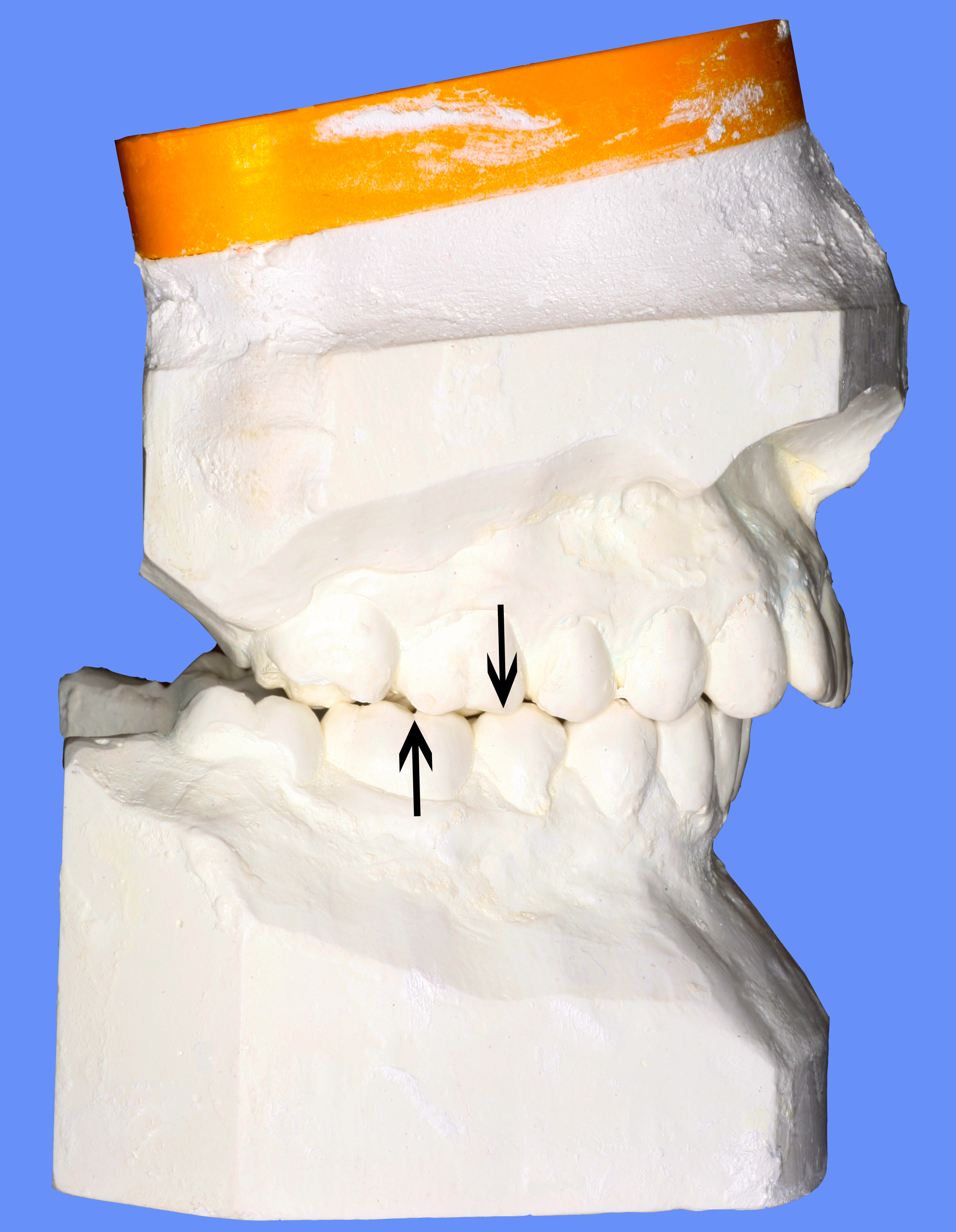 Clase II molar