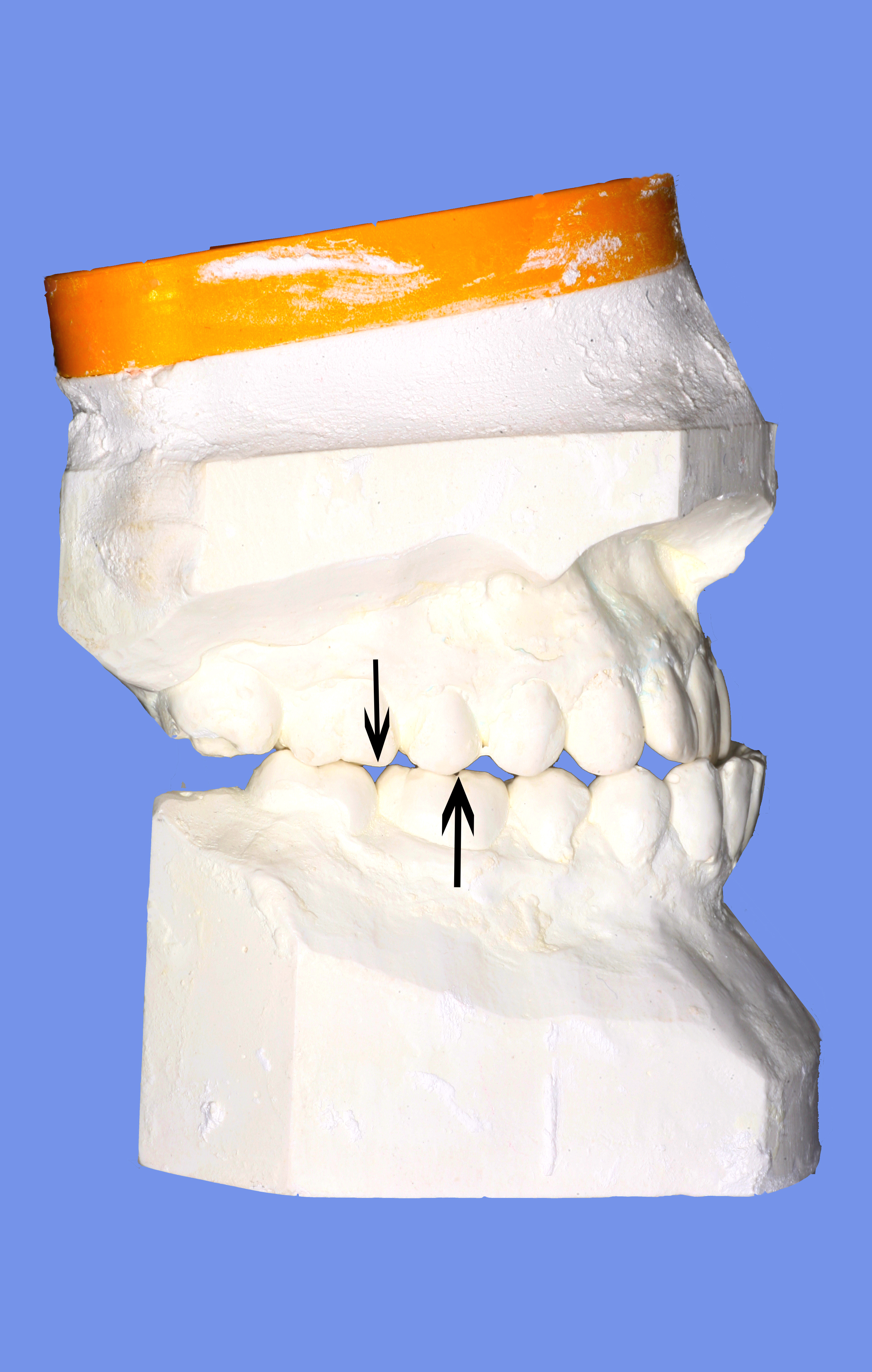 Clase III molar