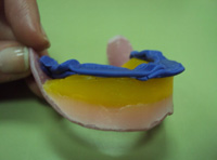 Silicona de oclusión sobre el rodete inferior y con las marcas del superior que permiten relacionar ambas planchas.