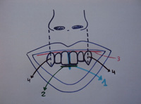 Esquema representativo de las marcas que hay que hacer en el rodete de la plancha superior para determinar el tipo de dientes.
