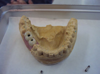 Prueba de biscuit de dos fundas sobre implantes que se encuentran sobre un modelo de yeso.
