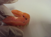 Sobredentadura superior con cuatro caballitos  vista de lado, para sujetarse sobre una barra sobre implantes.