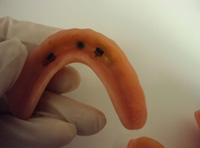 Sobredentadura inferior con tres caballitos para sujetarse sobre una barra sobre implantes.