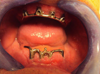 Paciente con barras sobre implantes en ambas arcadas.