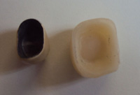 Fundas de zirconio y de metal-cerámica juntas vistas desde el interior para su comparación.