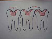 Esquema representativo de una incrustación dental: de un inlay y un onlay.