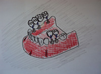 Dibujo con dos fundas y un puente de cuatro piezas sobre implantes.