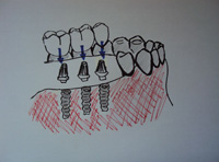 Dibujo con tres fundas sobre implantes y tres pilares par cementarlas.