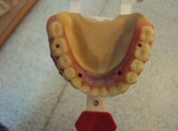 Prótesis híbrida sobre cuatro implantes vista desde la cara superior.