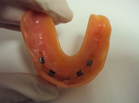 Sobredentadura superior con cuatro caballitos para sujetarse sobre una barra sobre implantes.