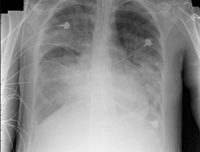 Radiografía de un paciente con insuficiencia respiratoria. Se observan las estructuras óseas y dos electrodos.