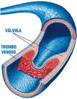 Sección de una arteria en la que se aprecia una válvula y un trombo venoso que se ha formado alrededor de ella, obstruyendo parcialmente la circulación de la sangre.