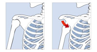 Ilustración en dos partes, de la estructura osea del hombro. En la primera se ve la articulación del hombro con la cabeza del húmero colocada en su sitio. En la segunda se ve la cabeza del húmero desplazada fuera de la articulación. Una flecha roja marca el sentido de desplazamiento desde el hombro en dirección a las costillas.