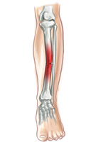 Ilustración de una pierna en la que se visualiza el hueso fracturado en su interior. La zona de la fractura está resaltada en color rojo y se aprecia una fina línea en la zona de la tibia.