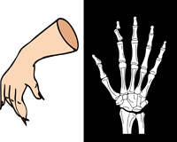 Ilustración en dos partes, una con fondo blanco en la que se ve una mano de mujer con una deformación del extremo del dedo índice. Al lado con fondo negro se ve una imagen se los huesos con una fractura completa del extremo del dedo índice.