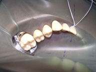 Imagen que muestra detalladamente un aislamiento múltiple en la arcada inferior colocando un clamp en la zona posterior e hilo en la anterior.