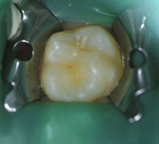 Imagen que muestra un molar superior aislado con dique de goma.