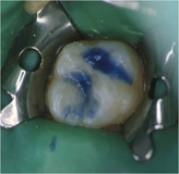 Imagen que muestra un molar superior con ácido ortofosfórico.