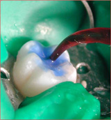 Imagen que muestra como se remueve el ácido de la superficie dental.