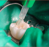 Imagen que muestra un pincel removiendo el adhesivo dentinario.