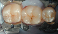 Imagen que muestra un aislamiento múltiple para realizar posteriormente la ameloplastia.