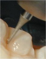 Imagen que muestra la acción de la fresa de mínima invasión en las fisuras dentales.