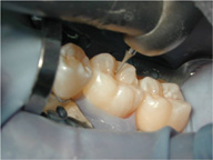 Imagen que muestra de lejos la fresa de mínima invasión y la turbina dental.