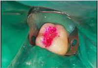 Imagen que muestra como se plica el caries detector rosa en la superficie dental. 
